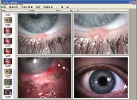 Fundus Camera Image
